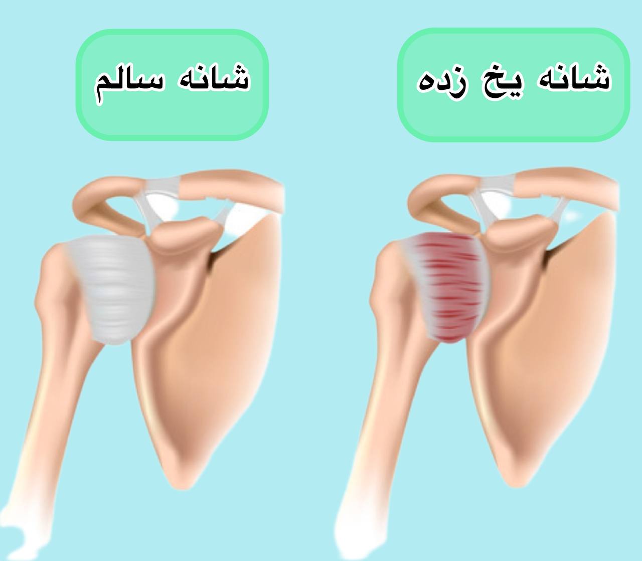 شانه یخ زده