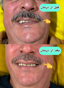 الکترواکوپاکنچر برای فلج بلز