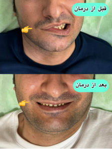 الکترواکوپاکنچر برای فلج بلز