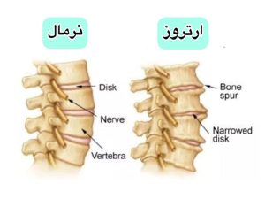آرتروز گردن