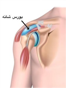 بورسیت شانه