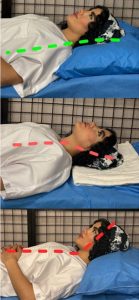 آرتروز گردن