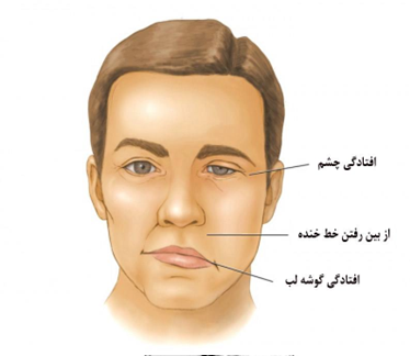  دلیل بیماری فلج بلز