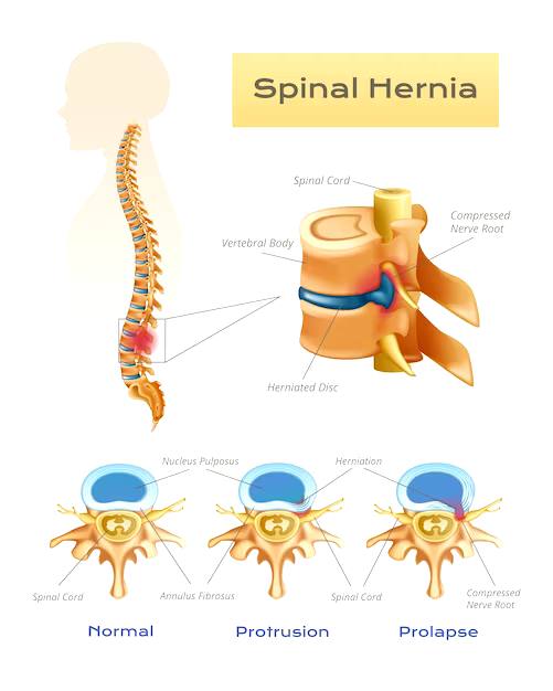 دیسک ستون فقرات و هسته آن